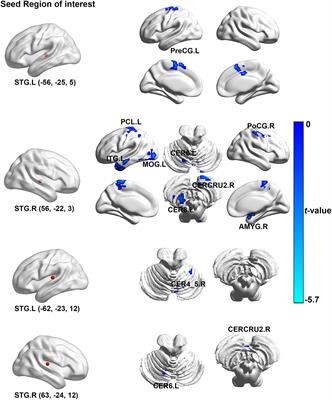 Aberrant Functional and Causal Connectivity in Acute Tinnitus With Sensorineural Hearing Loss